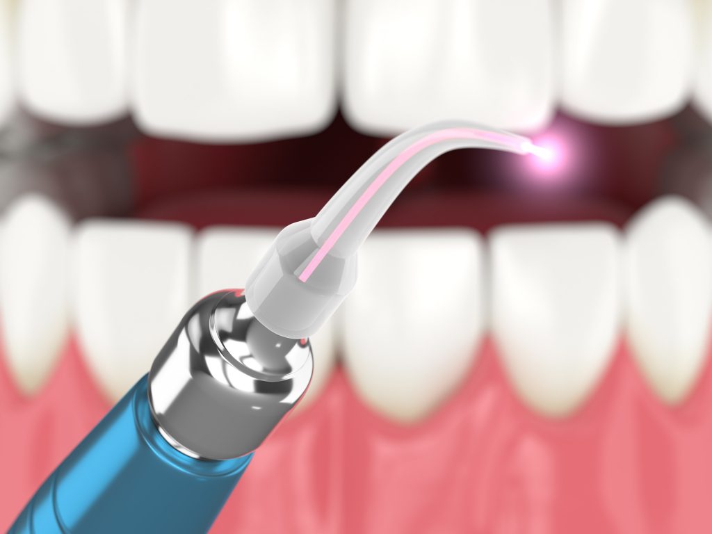 laser dentistry